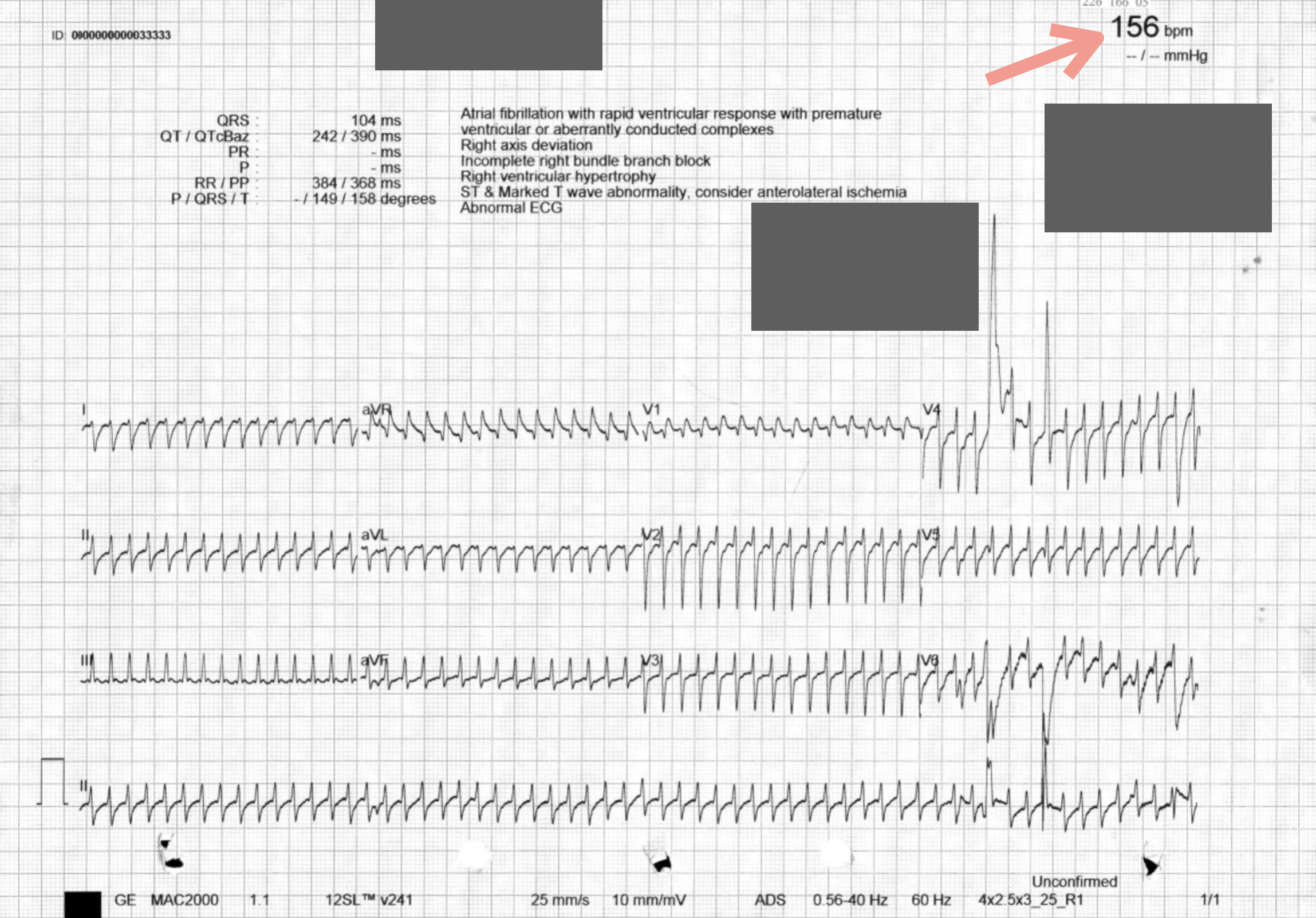 到院後ECG