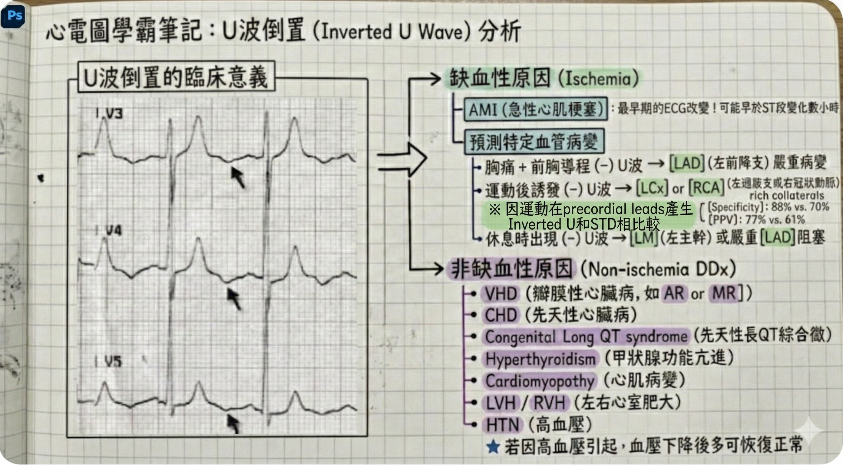 Inverted U wave