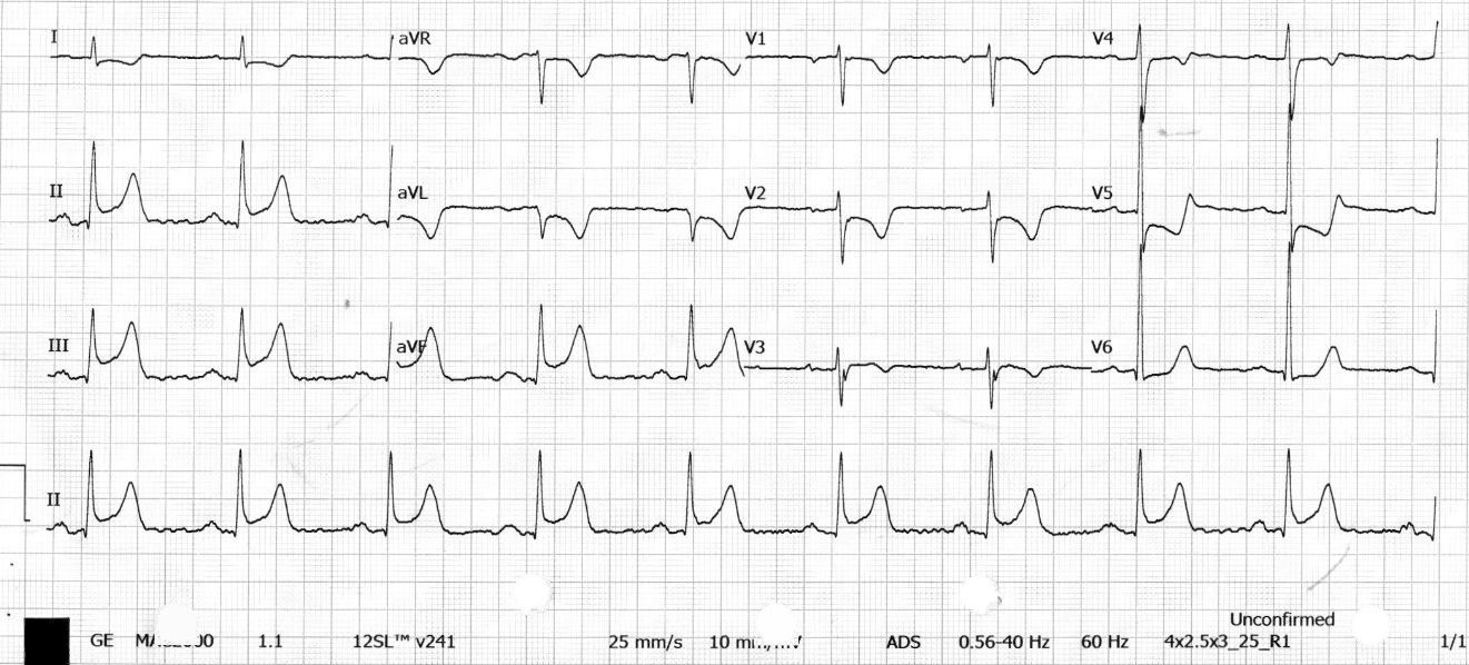 到院 ECG