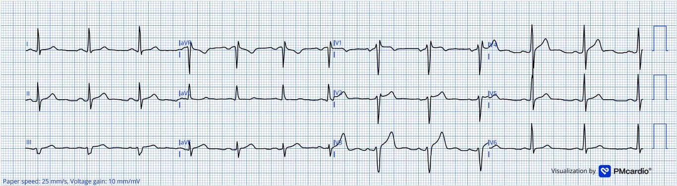 Helseth 等人 2026 貫穿全文病例的第一張 ECG