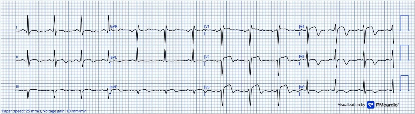 同一位病人 16 分鐘後的第二張 ECG