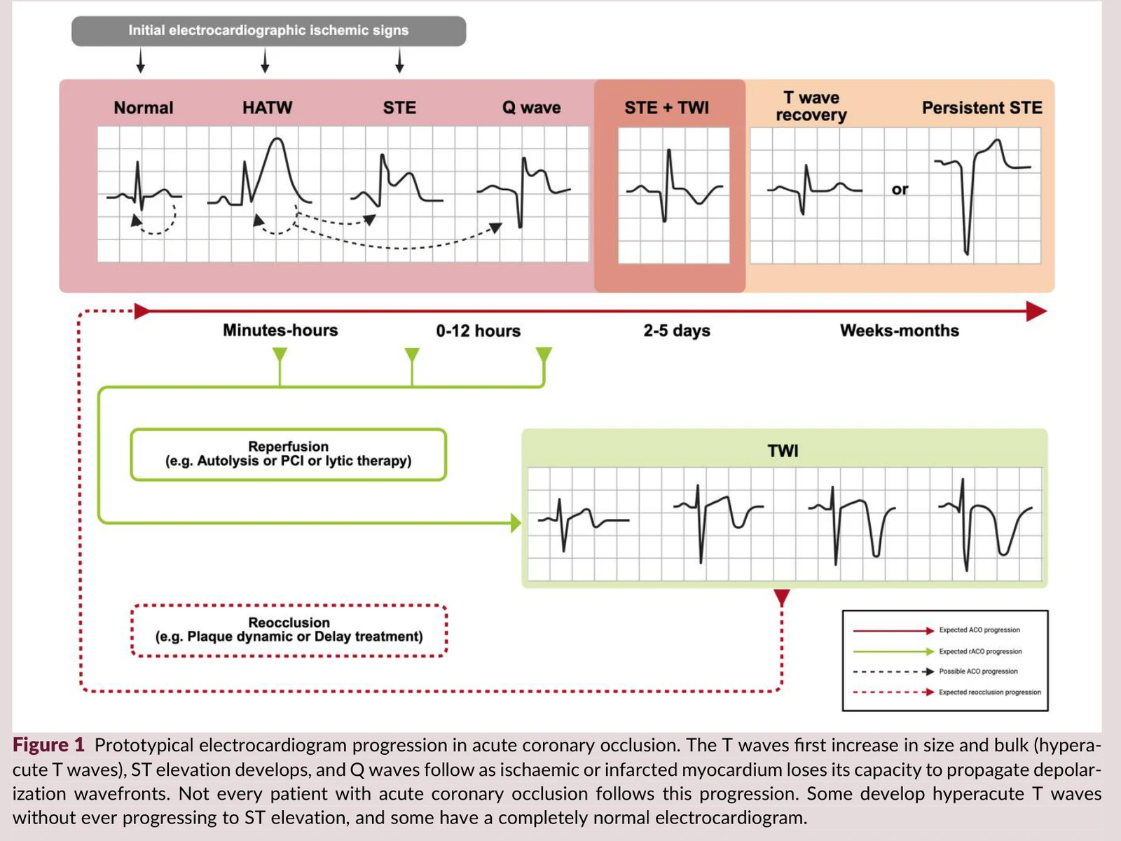原文 Figure 1：急性冠狀動脈阻塞時 ECG 的典型演變