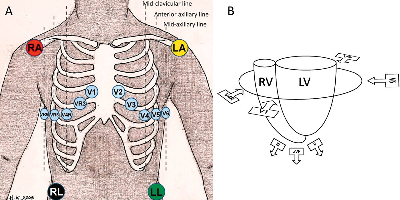 right side ECG