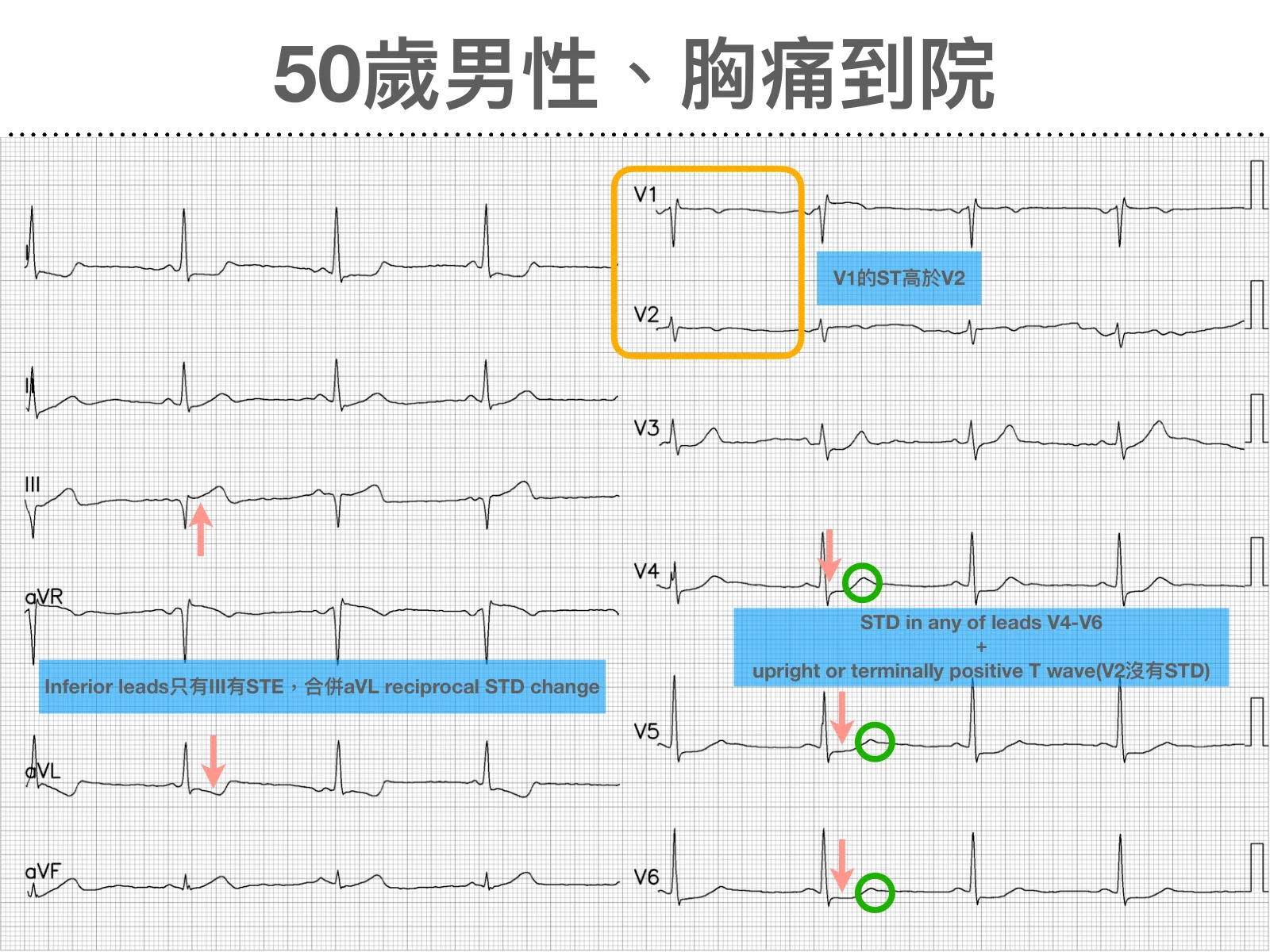 12導程心電圖，標題「50歲男性、胸痛到院」。左半I/II/III/aVR/aVL/aVF：III導程紅色向上箭頭標STE、aVL導程紅色向下箭頭標reciprocal STD，藍底文字「Inferior leads只有III有STE，合併aVL reciprocal STD change」。右半V1–V6：橘框圈住V1/V2，藍底文字「V1的ST高於V2」；V4/V5/V6各有紅色向下箭頭與綠色空心圈，藍底文字「STD in any of leads V4-V6 + upright or terminally positive T wave(V2沒有STD)」
