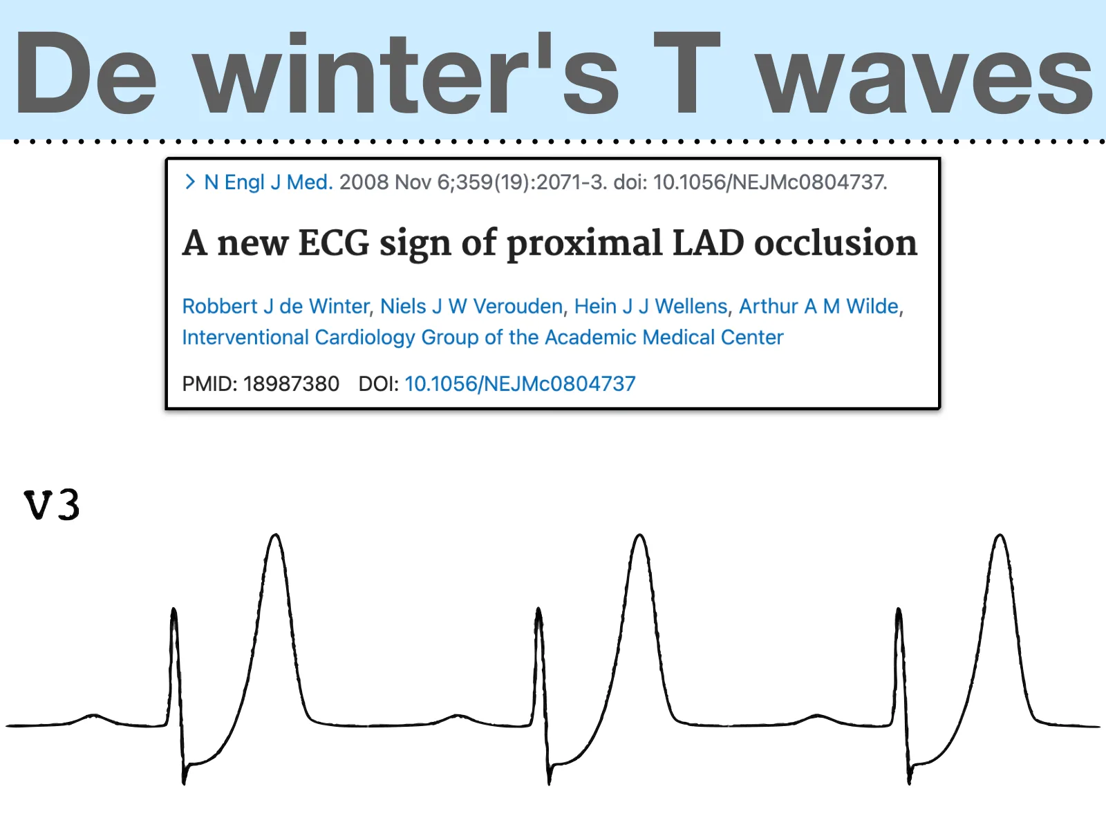 投影片「De winter's T waves」：中間黑框是PubMed書目頁截圖，可見「N Engl J Med. 2008 Nov 6;359(19):2071-3. doi: 10.1056/NEJMc0804737.」、標題「A new ECG sign of proximal LAD occlusion」、作者「Robbert J de Winter, Niels J W Verouden, Hein J J Wellens, Arthur A M Wilde, Interventional Cardiology Group of the Academic Medical Center」與「PMID: 18987380　DOI: 10.1056/NEJMc0804737」；下方是V3導程的線條示意圖，三個心跳，QRS之後先往下陷，再往上斜接進高聳對稱的T wave。