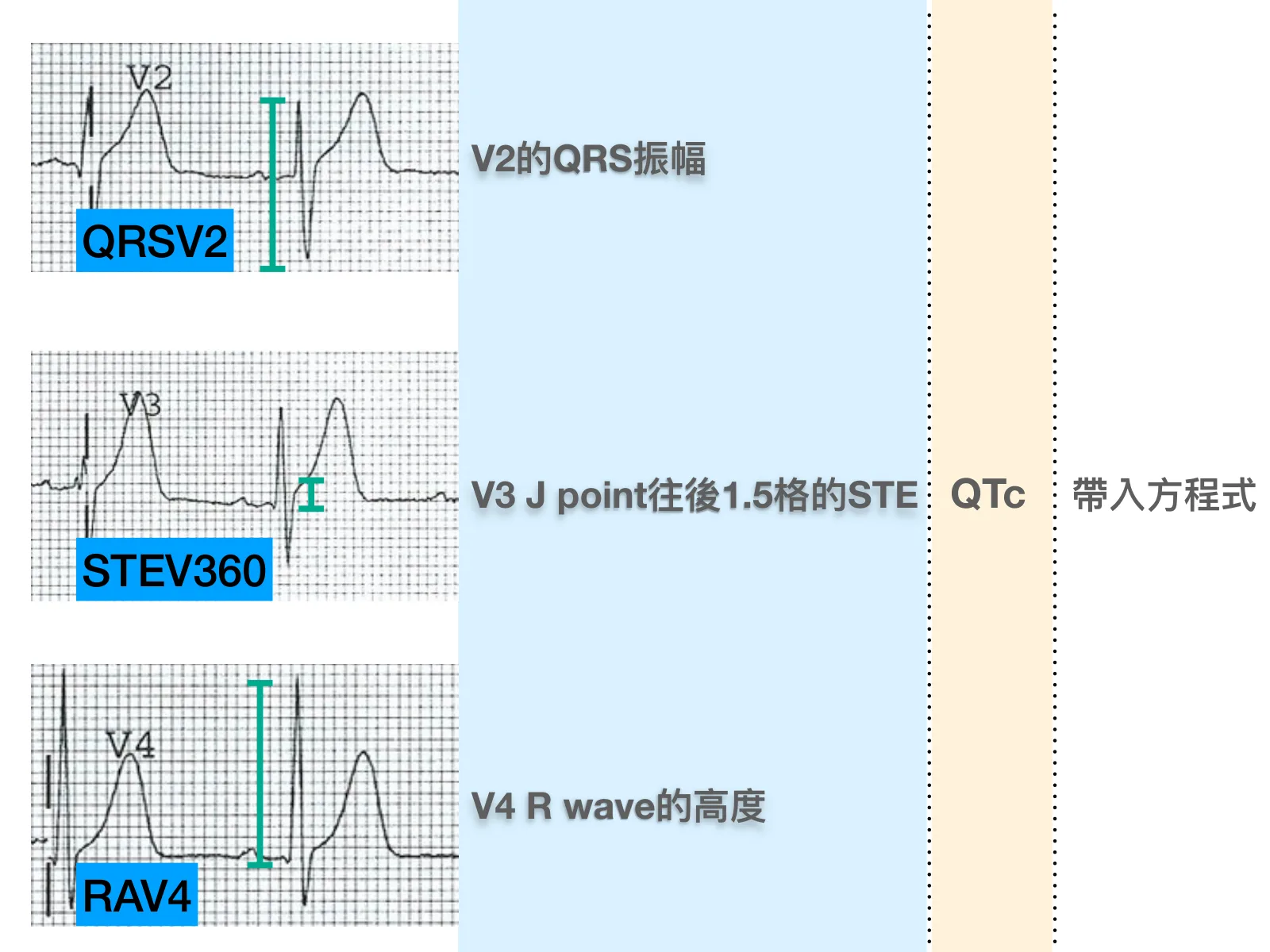 投影片左側是V2、V3、V4三段心電圖局部，綠色量尺分別標QRSV2、STEV360、RAV4；中間文字依序寫「V2的QRS振幅」「V3 J point往後1.5格的STE」「V4 R wave的高度」，右側兩欄寫「QTc」「帶入方程式」