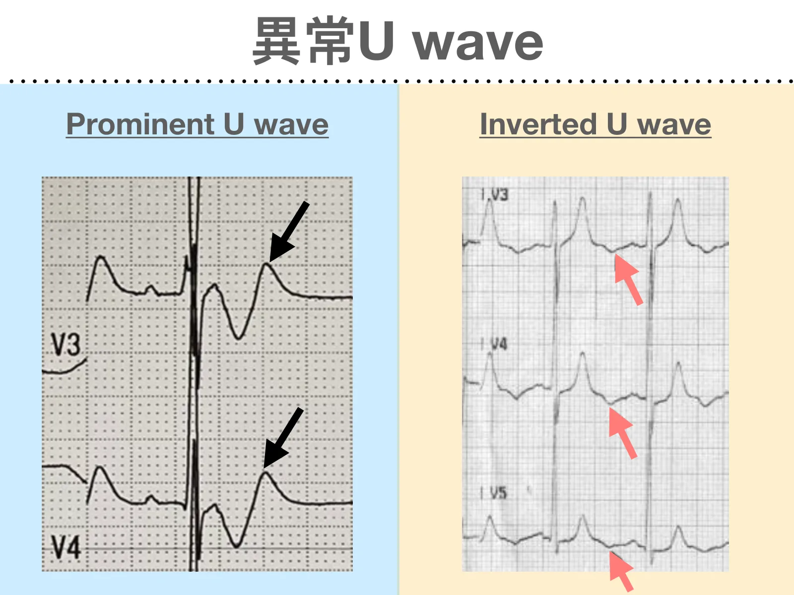 投影片「異常U wave」左右對照：左側淺藍底「Prominent U wave」，V3、V4 各有一個黑色箭頭指向 T 波後方向上的 U wave；右側米黃底「Inverted U wave」，V3、V4、V5 各有一個粉紅色箭頭指向 T 波後方向下的 U wave。