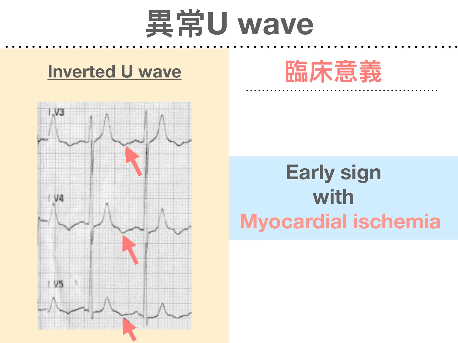 投影片「異常U wave」：左側米黃底「Inverted U wave」為V3、V4、V5三個導程的心電圖，粉紅色箭頭指向T波後方向下凹陷的U wave；右側「臨床意義」，藍底大字「Early sign」「with」「Myocardial ischemia」。