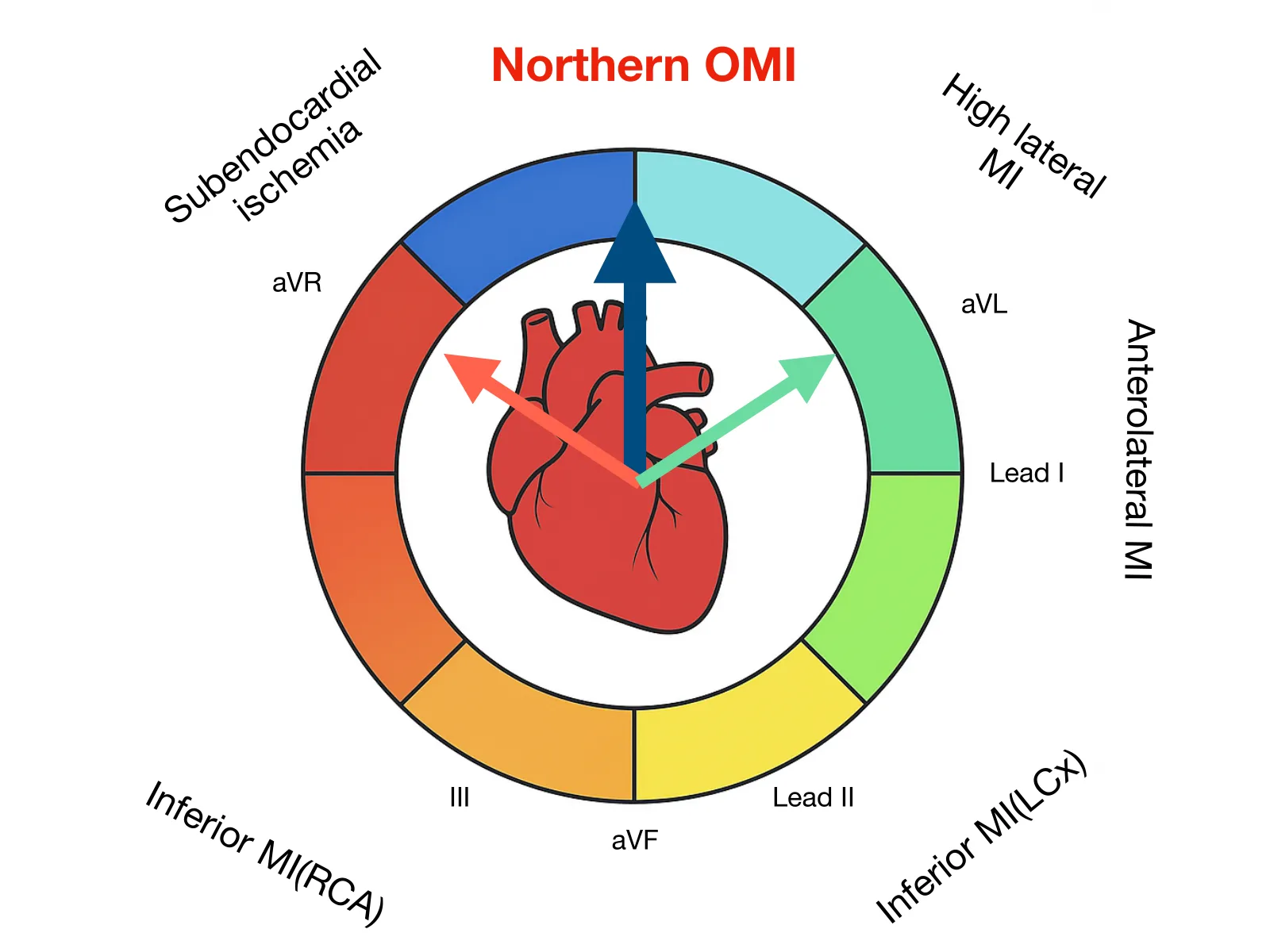 投影片「Northern OMI」：彩色圓環分成八格，外圍標著導程（aVR、aVL、Lead I、Lead II、aVF、III）與對應區域（Subendocardial ischemia、High lateral MI、Anterolateral MI、Inferior MI(LCx)、Inferior MI(RCA)）；圓環中間是一顆卡通心臟，三個箭頭從中心出發：紅色指向 aVR、綠色指向 aVL、深藍色直指正上方。