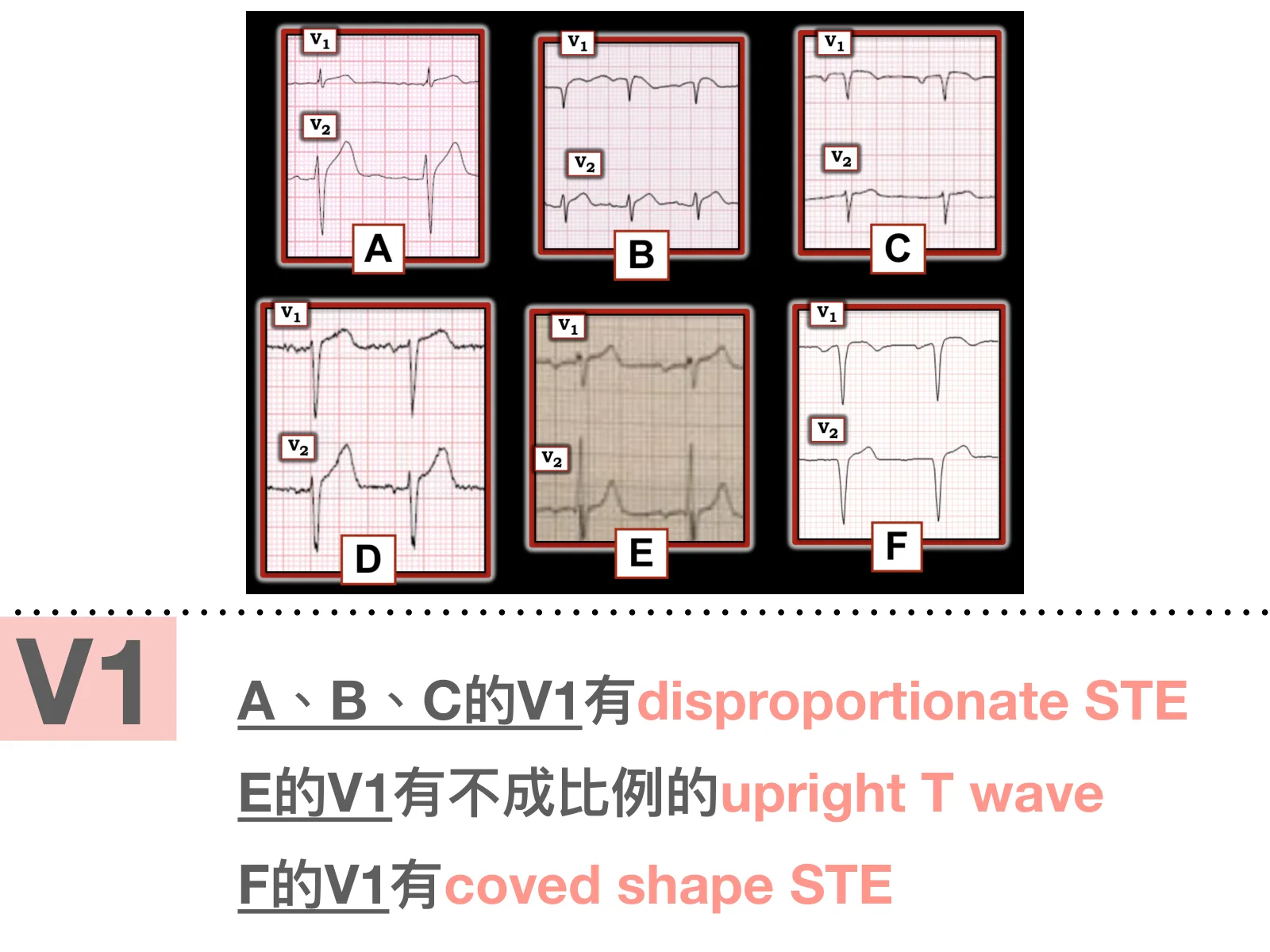 投影片上方是六格V1/V2導程心電圖（黑底紅框，標示A至F，Ken Grauer整理的圖），下方粉紅色大字「V1」，右側文字「A、B、C的V1有disproportionate STE」「E的V1有不成比例的upright T wave」「F的V1有coved shape STE」