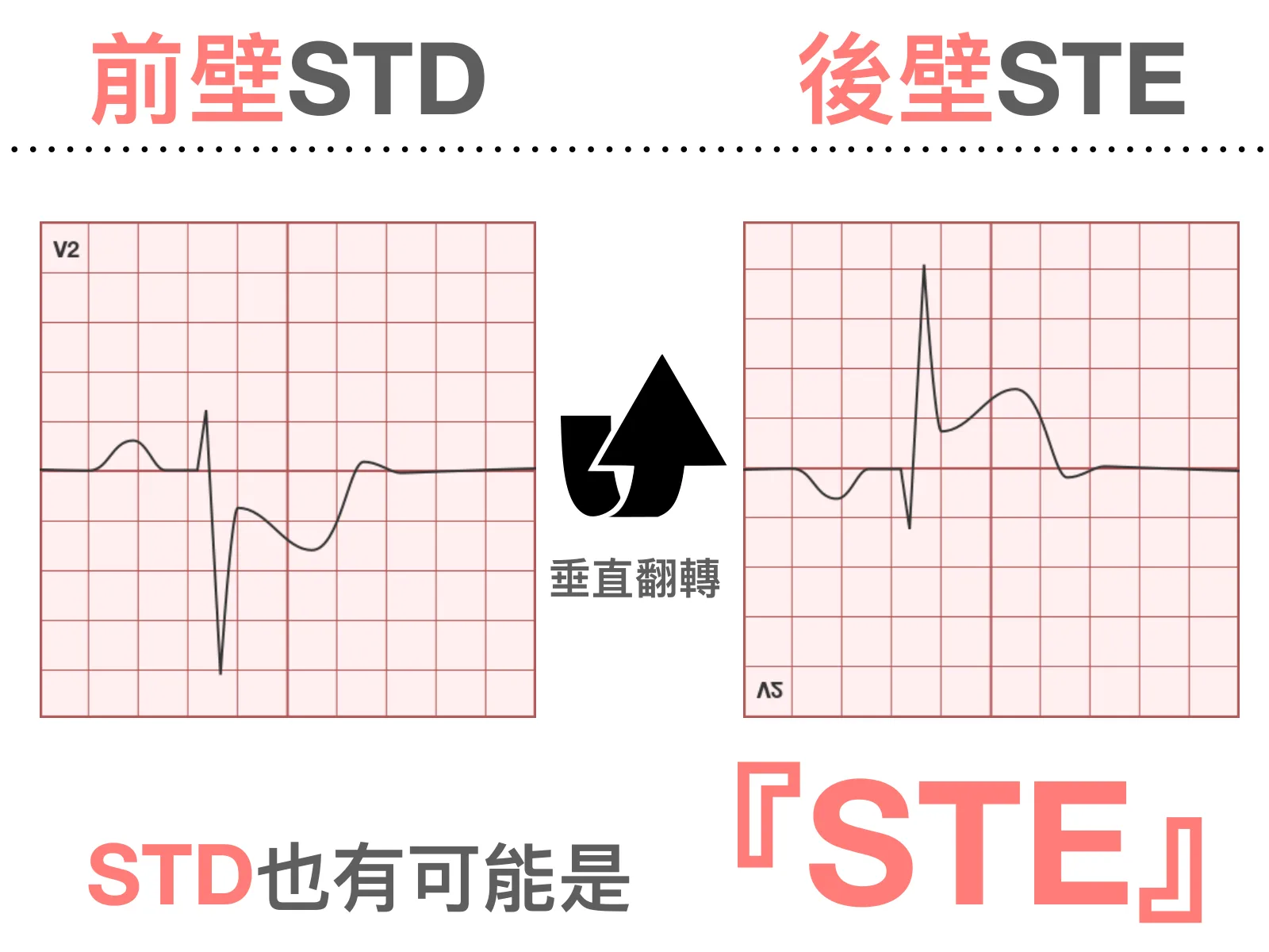 投影片左右並排兩張 V2 導程示意圖：左邊標題「前壁STD」，QRS 之後 ST 段往下壓；右邊標題「後壁STE」，是同一個波形上下翻轉後的樣子，ST 段變成往上抬；中間黑色箭頭寫「垂直翻轉」，下方大字「STD也有可能是『STE』」。