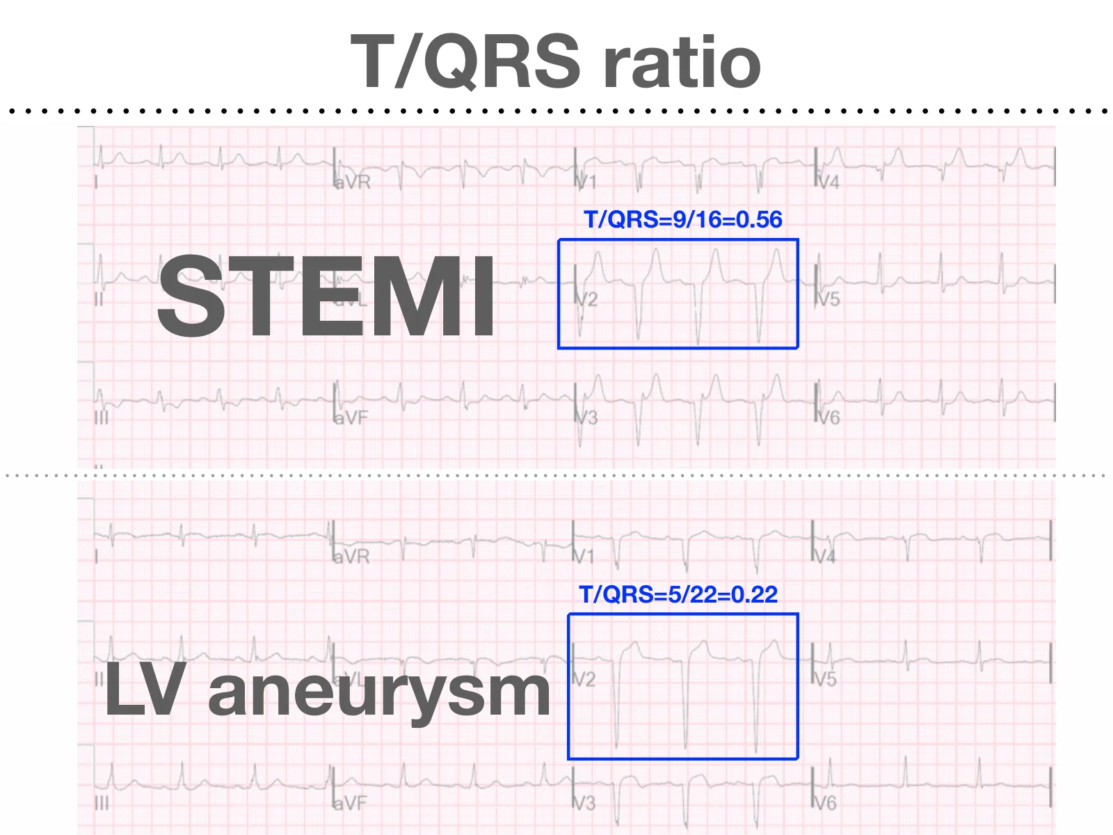 投影片標題「T/QRS ratio」：上排標STEMI的12導極心電圖，V2藍框標示T/QRS=9/16=0.56；下排標LV aneurysm的12導極心電圖，V2藍框標示T/QRS=5/22=0.22，兩張心電圖上下對照