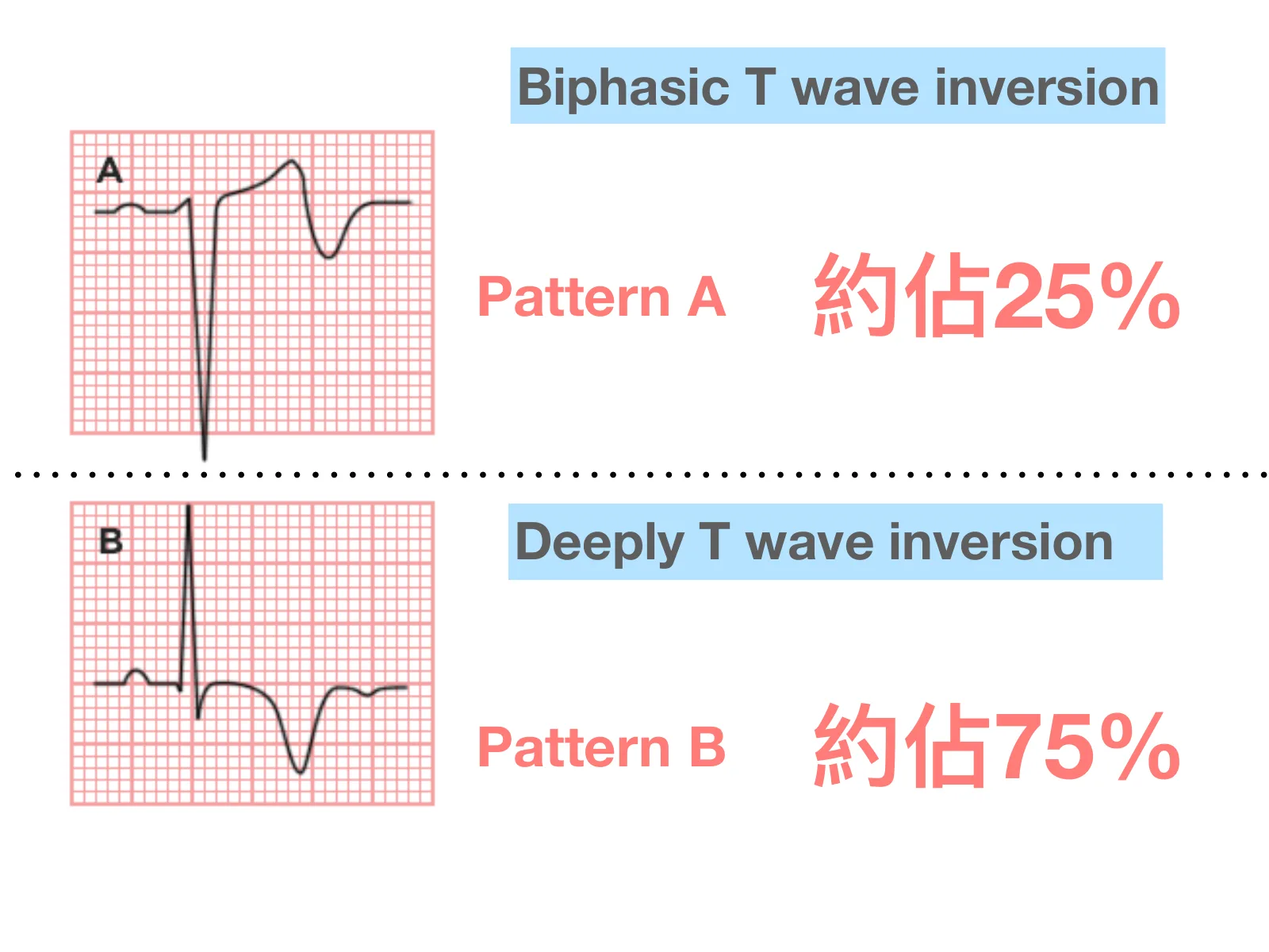 投影片左側兩張 T 波示意圖：上方標 A，配文字「Biphasic T wave inversion」與粉紅色大字「Pattern A　約佔25%」；下方標 B，配文字「Deeply T wave inversion」與粉紅色大字「Pattern B　約佔75%」。